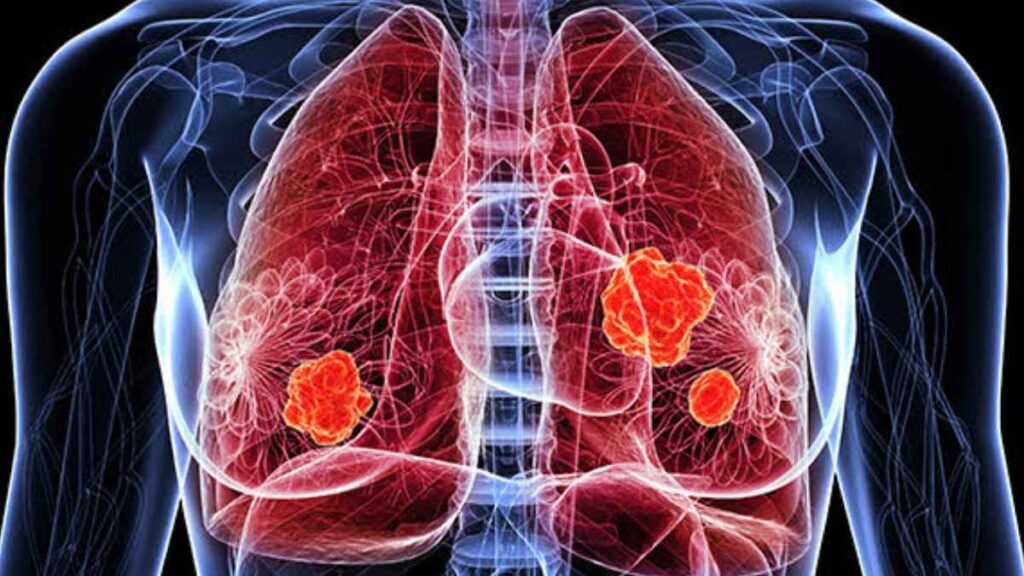 Radiographie d'un cancer du poumon.